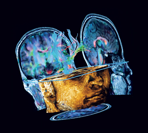 an image from the fMRI showing a cross section of the head